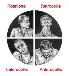 Spasmodic Torticollis